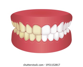Teeth whitening vector illustration | before and after 