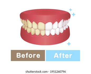 Teeth whitening vector illustration | before and after 