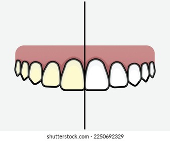 Zähne, weißer Vektor von gelben Zähnen bis zu weißen Zähnen vor und nach Vektorgrafik