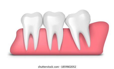 Teeth With Wisdom Mesial Impaction Problem. EPS10 Vector