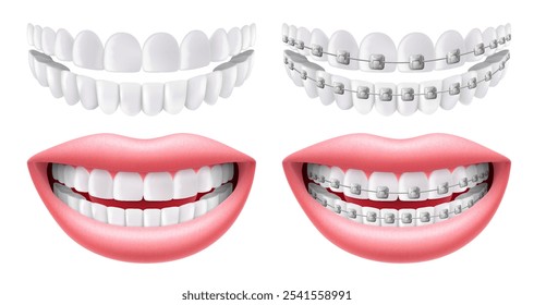 Dentes com ou sem aparelho. Aparelhos de arco sem dentes. Odontologia ortodôntica. O alinhamento dos dentes. Sorria com dentes e aparelho brancos. Vetor 3d realista isolado