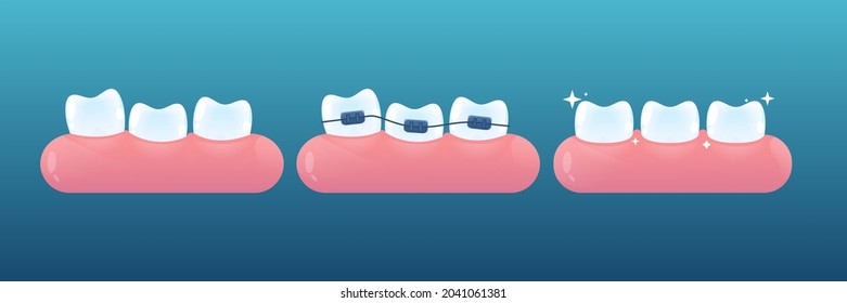 Teeth with or without braces. Orthodontic dentistry. Brace correction concept. Vector cartoon style