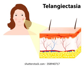 Telangiectasias. Spider Veins Or Angioectasias. Veins On The Face