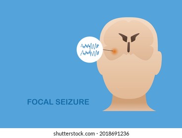 Temporal Lobe Epilepsy. Vector Illustration Of Human Focal Seizure. Abnormal Brain Waves Arising From The Side Of Brain