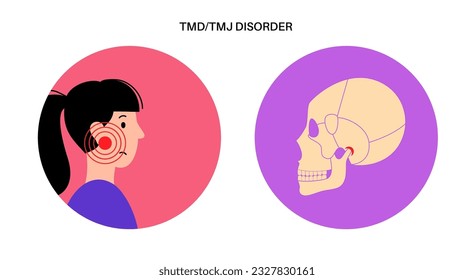 Temporomandibular joint disorder. TMD or TMJ dysfunction. Pain in the jaw joint, temporal bone locking or displaced disc. Transcutaneous electrical nerve stimulation. Human skull and mandible vector