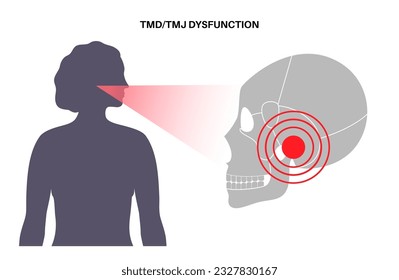 Temporomandibular joint disorder. TMD or TMJ dysfunction. Pain in the jaw joint, temporal bone locking or displaced disc. Transcutaneous electrical nerve stimulation. Human skull and mandible vector