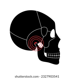 Temporomandibular joint disorder. TMD or TMJ dysfunction. Pain in the jaw joint, temporal bone locking or displaced disc. Transcutaneous electrical nerve stimulation. Human skull and mandible vector