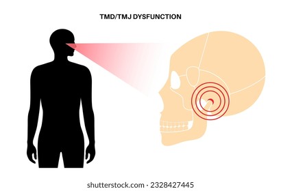 Temporomandibular joint disorder. TMD or TMJ dysfunction. Pain in the jaw joint, temporal bone locking or displaced disc. Transcutaneous electrical nerve stimulation. Human skull and mandible vector