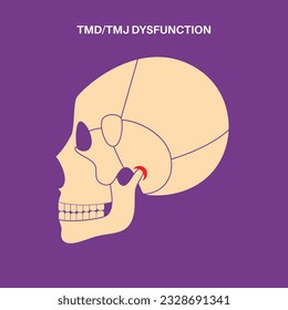 Temporomandibular joint disorder. TMD or TMJ dysfunction. Pain in the jaw joint, temporal bone locking or displaced disc. Transcutaneous electrical nerve stimulation. Human skull and mandible vector