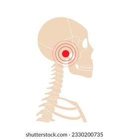 Temporomandibular joint disorder. TMD or TMJ dysfunction. Pain in the jaw joint, temporal bone locking or displaced disc. Transcutaneous electrical nerve stimulation. Human skull and mandible vector