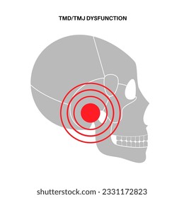 Temporomandibular joint disorder. TMD or TMJ dysfunction. Pain in the jaw joint, temporal bone locking or displaced disc. Transcutaneous electrical nerve stimulation. Human skull and mandible vector