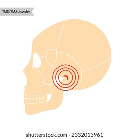 Temporomandibular joint disorder. TMD or TMJ dysfunction. Pain in the jaw joint, temporal bone locking or displaced disc. Transcutaneous electrical nerve stimulation. Human skull and mandible vector