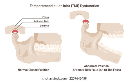 Temporomandibular joint disorder or TMJ. Condition affecting the jaw joints and surrounding muscles and ligaments. Lower jaw bone joint dislocation. Flat vector illustration