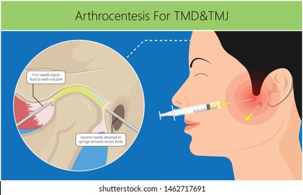 Temporomandibuläre Gelenkerkrankungen TMD TMJ behandelt Schmerzen verdrängte Scheiben-Scheiben-Verschluss Plättchen Kunststoff-Nacht Transkutane elektrische Nervenstimulation TENS Arthroscopy ocklusal