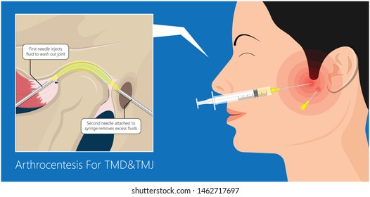 Temporomandibular Joint Disorders TMD TMJ treat pain displaced disc temporal bone locking bite plate plastic guard night Transcutaneous electrical nerve stimulation TENS Arthroscopy occlusal