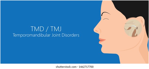 Temporomandibuläre Gelenkerkrankungen TMD TMJ behandelt Schmerzen verdrängte Scheiben-Scheiben-Verschluss Plättchen Kunststoff-Nacht Transkutane elektrische Nervenstimulation TENS Arthroscopy ocklusal