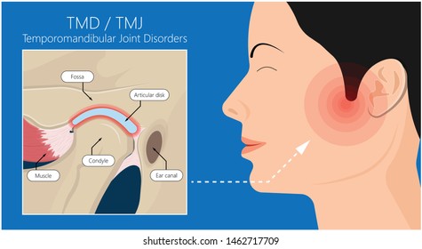 Temporomandibular Joint Disorders TMD TMJ treat pain displaced disc temporal bone locking bite plate plastic guard night Transcutaneous electrical nerve stimulation TENS Arthroscopy occlusal