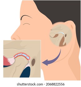 Temporomandibular Joint Disorders TMD TMJ treat pain displaced disc temporal bone locking bite plate plastic guard night Transcutaneous electrical nerve stimulation TENS Arthroscopy occlusal oral