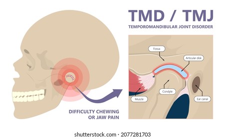 Temporomandibular Joint Disorders TMD TMJ treat pain displaced disc temporal bone locking bite plate plastic guard night Transcutaneous electrical nerve stimulation TENS Arthroscopy occlusal oral