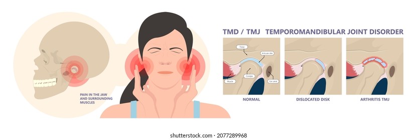 Temporomandibular Joint Disorders TMD TMJ treat pain displaced disc temporal bone locking bite plate plastic guard night Transcutaneous electrical nerve stimulation TENS Arthroscopy occlusal oral