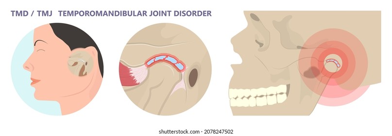 Temporomandibular Joint Disorders TMD TMJ treat pain displaced disc temporal bone locking bite plate plastic guard night Transcutaneous electrical nerve stimulation TENS Arthroscopy occlusal oral