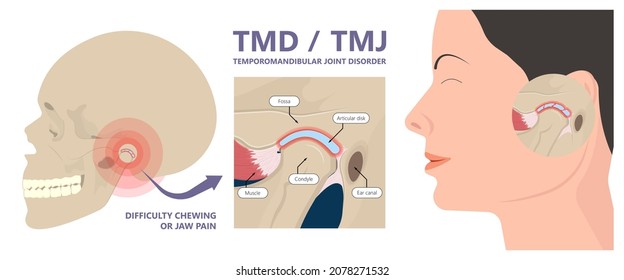 Temporomandibular Joint Disorders TMD TMJ treat pain displaced disc temporal bone locking bite plate plastic guard night Transcutaneous electrical nerve stimulation TENS Arthroscopy occlusal oral