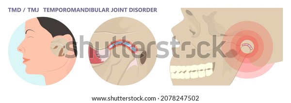 Temporomandibular Joint Disorders Tmd Tmj Treat Stock Vector (Royalty ...