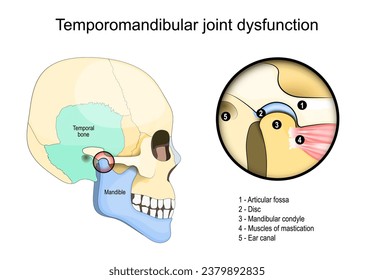 Temporomandibuläres Gelenkdysfunktionssyndrom. Seitenansicht eines menschlichen Schädels mit temporalem Knochen. Nahaufnahme von Muskeln der Mastitis und Gelenk, die das Mandel mit dem Schädel verbinden. Vektorgrafik