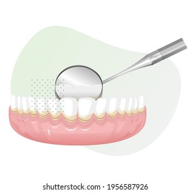 Tender-Gums mit Plaque - Dental Checkup - Stockillustration als EPS10-Datei