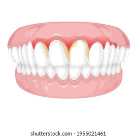 Tender Gums with Plaque - stock illustration as EPS 10 File