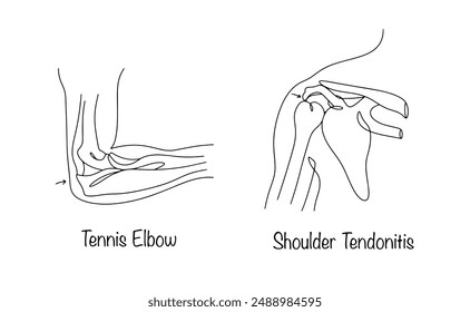 Tendinitis of the elbow and shoulder joints. Inflammation of tendons or their sheaths, usually caused by chronic microtrauma. Isolated medical illustration on white background.