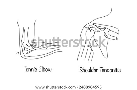 Tendinitis of the elbow and shoulder joints. Inflammation of tendons or their sheaths, usually caused by chronic microtrauma. Isolated medical illustration on white background.