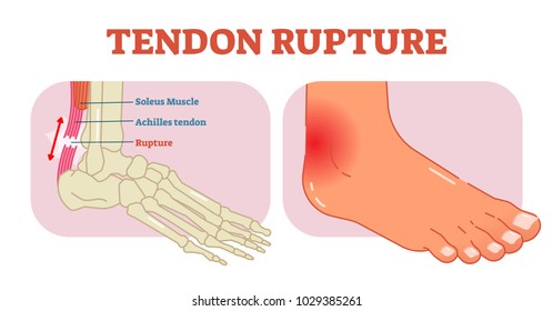 Tendons High Res Stock Images Shutterstock