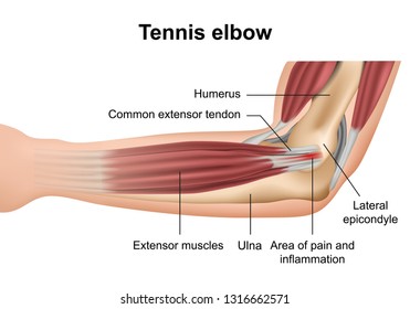 Tennis elbow injury medical vector illustration on white background