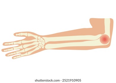 Tennis elbow outer elbow becomes painful due to overuse. It's related to repetitive strain injuries like golfer's elbow, tendinitis, and bursitis in the arm or wrist.