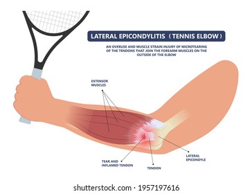 Tennis elbow pain inflammation tendon grip weak Golfer golf sport wrist brace tissue rupture limb arm