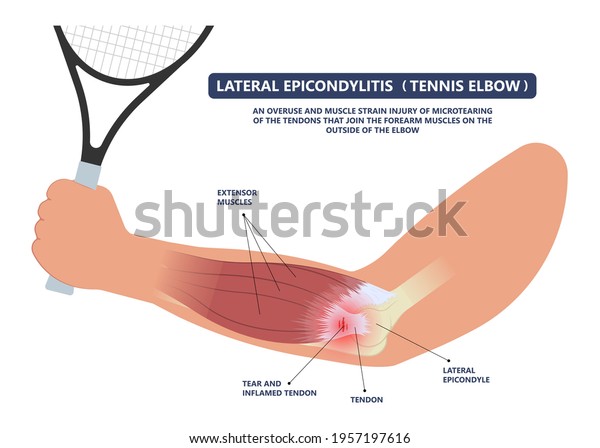 Tennis elbow pain\
inflammation tendon grip weak Golfer golf sport wrist brace tissue\
rupture limb arm