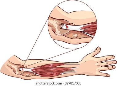 Tennis elbow - tear in the common extensor tendon of the arm