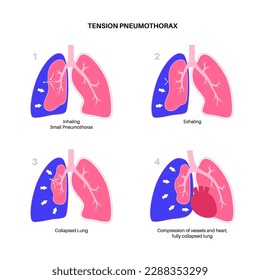 Pneumothorax-Erkrankung der Spannungen Verringerung der Blutmenge, die wieder ins Herz gelangt. Verletzung der Lunge oder der Brustwand. Brustschmerzen, Kurzatmigkeit. Ungesunde innere Organe im Atemsystem, Vektorgrafik