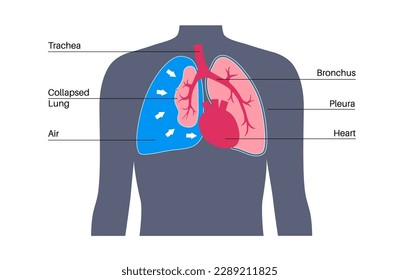 Enfermedad neumotórax de tensión. Reducir la cantidad de sangre regresó al corazón. Lesiones pulmonares o de pared torácica. Dolor torácico, dificultad para respirar. Órganos internos insalubres en el vector del sistema respiratorio