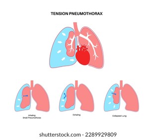 Pneumothorax-Erkrankung der Spannungen Verringerung der Blutmenge, die wieder ins Herz gelangt. Verletzung der Lunge oder der Brustwand. Brustschmerzen, Kurzatmigkeit. Ungesunde innere Organe im Atemsystem, Vektorgrafik