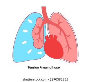 Enfermedad neumotórax de tensión. Reducir la cantidad de sangre regresó al corazón. Lesiones pulmonares o de pared torácica. Dolor torácico, dificultad para respirar. Órganos internos insalubres en el vector del sistema respiratorio