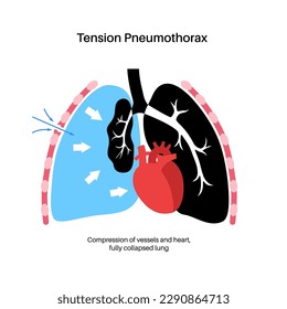 Enfermedad neumotórax de tensión. Reducir la cantidad de sangre regresó al corazón. Lesiones pulmonares o de pared torácica. Dolor torácico, dificultad para respirar. Órganos internos insalubres en el vector del sistema respiratorio
