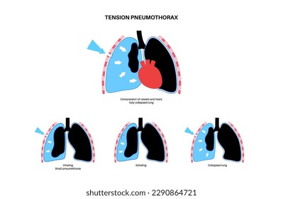 Tension pneumothorax disease. Reducing the amount of blood returned to the heart. Lung or chest wall injury. Chest pain, shortness of breathing. Unhealthy internal organs in respiratory system vector