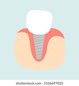 Tental Implants in Cases of Tooth Loss