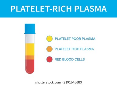 Test Tube Filled With Blood After Centrifugation Of Whole Blood For PRP Therapy. Platelet Rich Plasma Platelet Poor Plasma And Red Blood Cells. Preperation For Platelet-Rich Plasma (PRP) Injection.