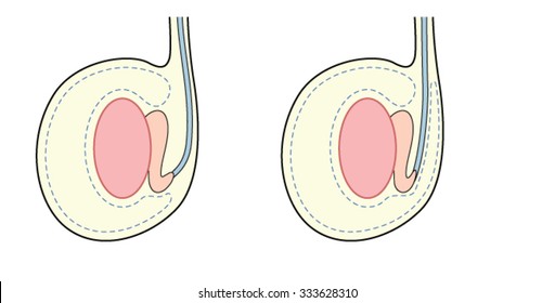 Testicle With High Tunica Vaginalis, A Predisposing Factor In Testicular Torsion.