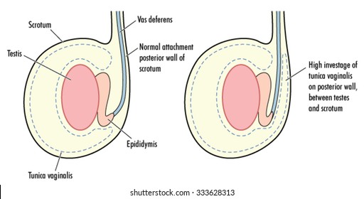 Testicle With High Tunica Vaginalis, A Predisposing Factor In Testicular Torsion.