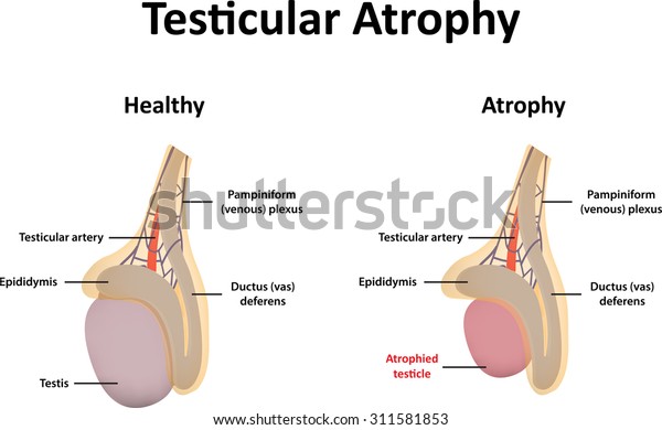 Testicular Atrophy Stock Vector Royalty Free 311581853 
