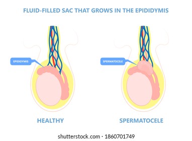 Testicular Disorder Men Vas Pus Tube Male Pain Cyst Test Exam Self Cord Vein Sperm Acute Blood Semen Tract Penis Viral Virus Tumor Fluid Testes Pelvic Sexual Penile Trauma System Prostate Testis